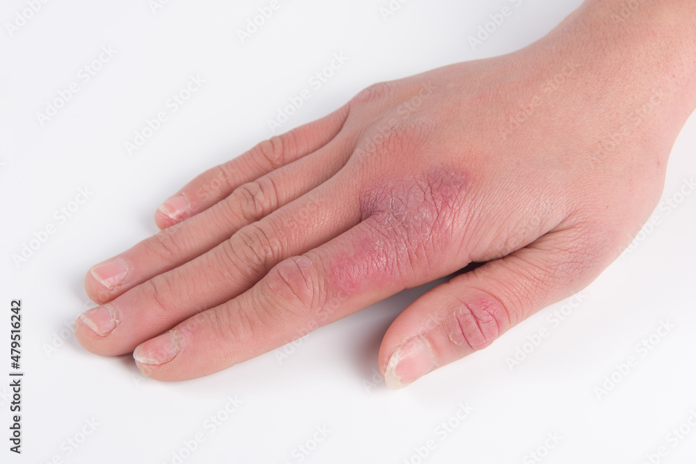 close up of female hand with chilblain on white background close up of female hand with chilblain on white background