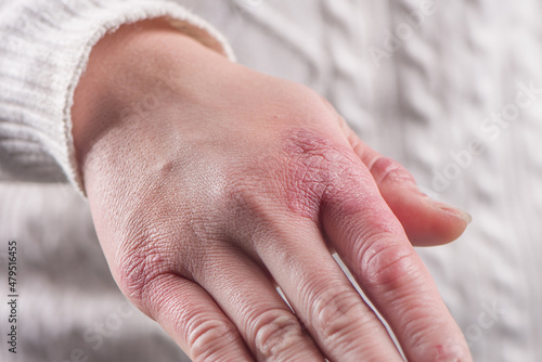 close up of female hand with chilblain on white background photo