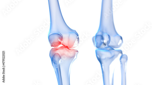 3d rendered illustration of a painful knee photo