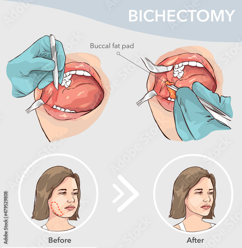 Buccal fat pad removal before and after vector illustration photo