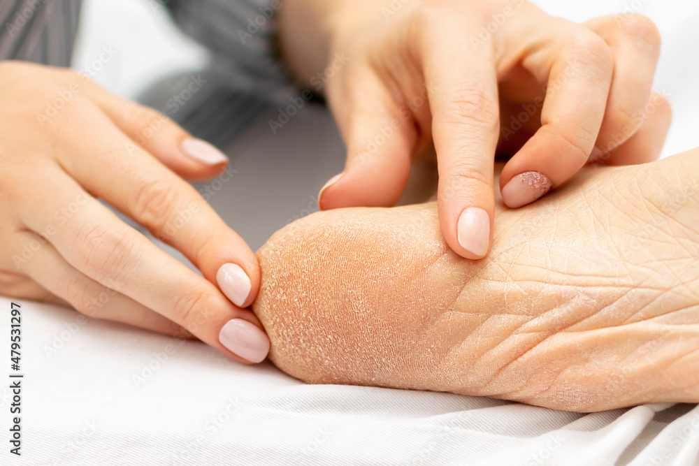Closeup of a womans hands touching the dry rough cracked skin of her