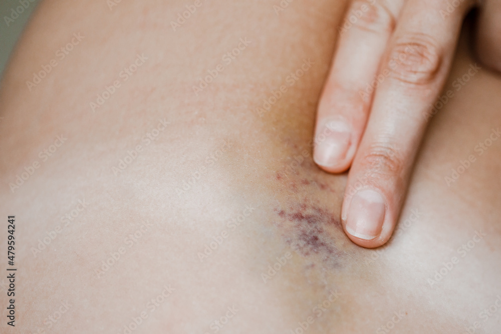 bruises and bruises on the girl's legs. bruises and bruises on the girl's legs.