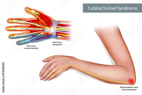 Medical illustration to explain Cubital tunnel syndrome. Ulnar nerve entrapment. Fascia involved in ulnar nerve compression. Vector photo