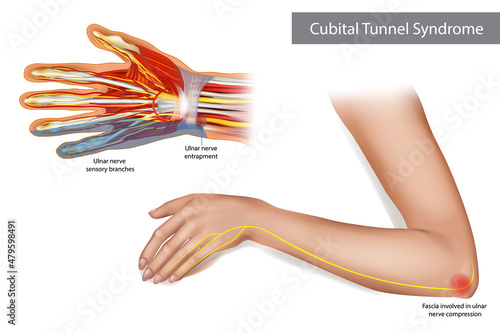 Medical illustration to explain Cubital tunnel syndrome. Ulnar nerve entrapment. Fascia involved in ulnar nerve compression. photo