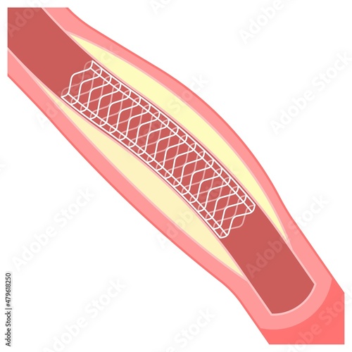 Angiography medical operation Angiogram Biopsy Angioplasty Stent Congenital Heart Defect Ablation CAG arteries plaque X-ray flow diagnose diagnosis blocked CABG valve atrial attack afib infarction