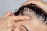 Woman is showing a serious problem of hair loss from her head