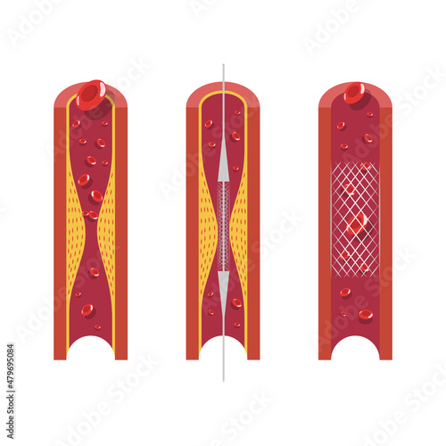 Stent used to open blocked artery on a white background