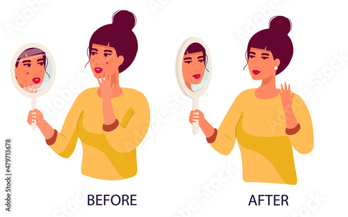 set of women sad Young woman hand mirror worrying about her acne on face in flat design. Pimple problem on female skin. and a satisfied girl with her skin condition. Before after