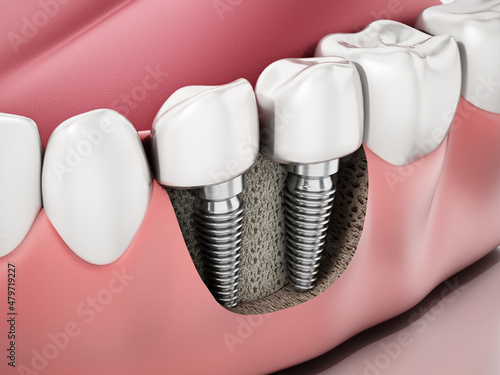3D illustration of two dental implants on the lower jaw