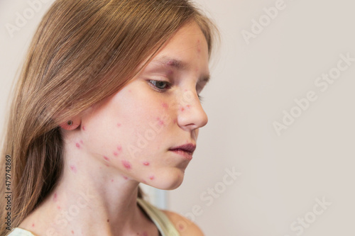 Fotografie Cute little girl with chickenpox at home. Varicella zoster virus.