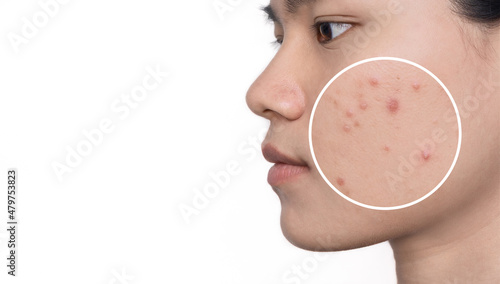 Close of a young woman with acne skin in zoom circle. Face of Asian females with circles shows problem skin before and after acne treatment. Beautician concept.