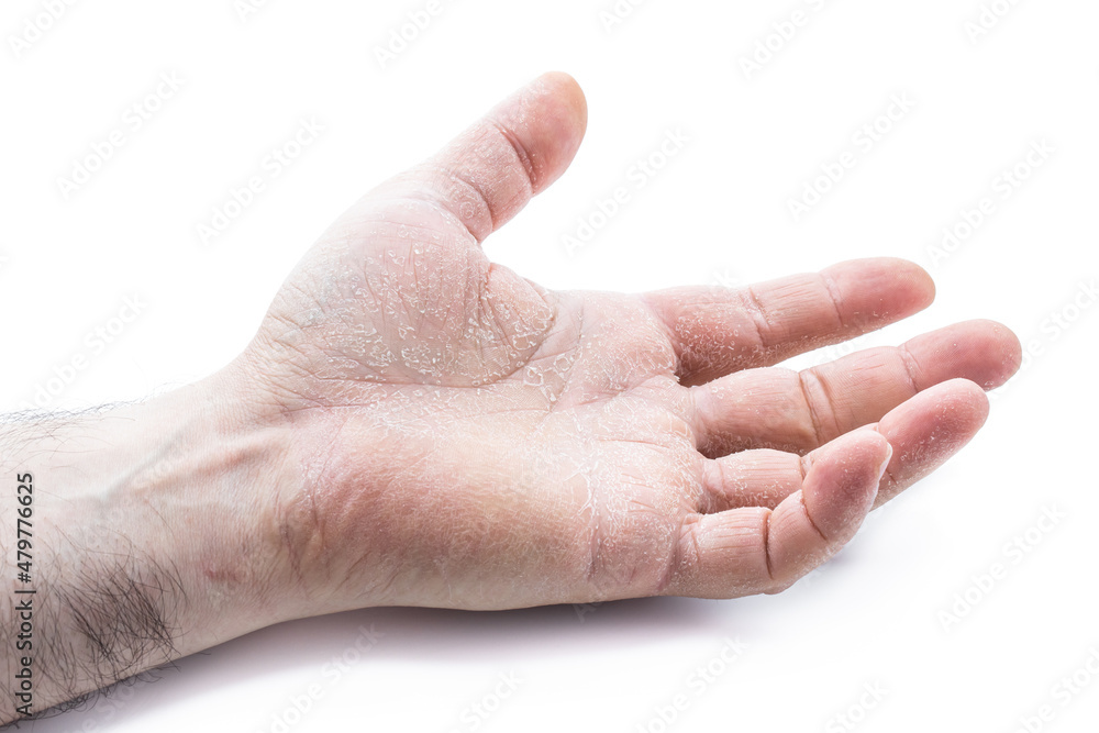 image of the mens hand showing skin disease isolated on white background image of the mens hand showing skin disease isolated on white background