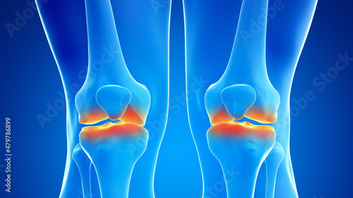 3d rendered illustration of painful knee joints