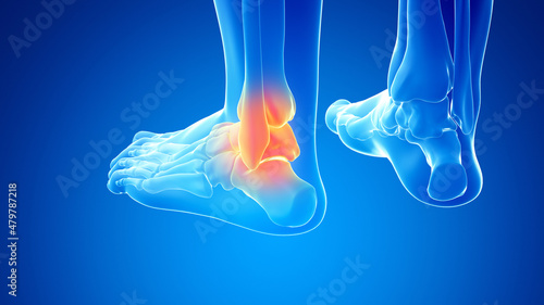 3d rendered illustration of a painful ankle joint