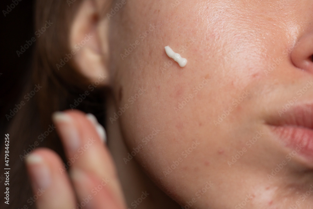 Closeup of a young woman applying prescription retinoid to her acne-prone skin with scarring and post-inflammatory erythema.