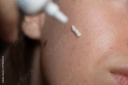 Obraz na płótnie Closeup of a young woman applying prescription retinoid to her acne-prone skin with scarring and post-inflammatory erythema. w salonie