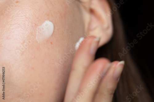 Closeup of a young woman applying prescription azelaic acid to her acne-prone skin with scarring and post-inflammatory erythema.