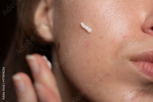 Obraz na płótnie Closeup of a young woman applying prescription retinoid to her acne-prone skin with scarring and post-inflammatory erythema. w salonie