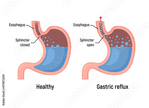 Esophageal gastric reflux acid indigestion. Gastrointestial stomach heartburn gerd gastric reflux