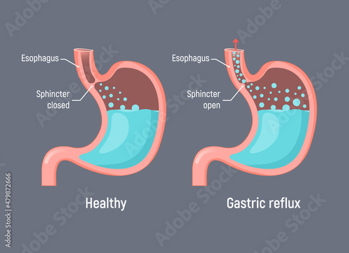 Esophageal gastric reflux acid indigestion. Gastrointestial stomach heartburn gerd gastric reflux photo