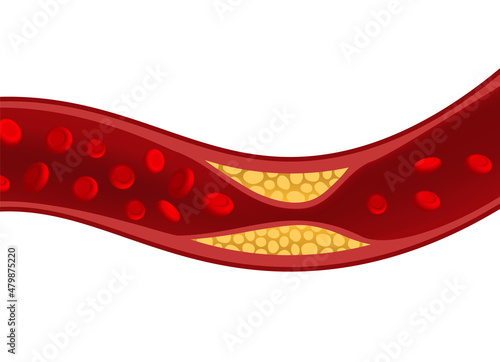 Cholesterol artery thrombosis micro vascular desease. Arteriosclerosis blood vector atherosclerosis risk