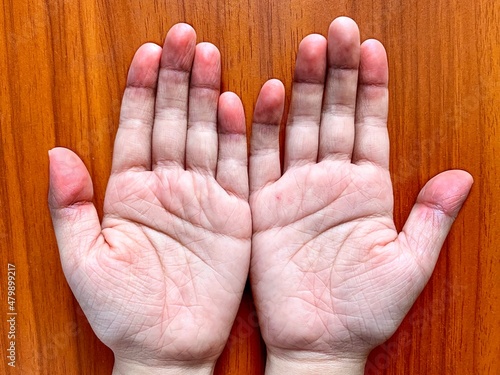 Cyanotic hands or peripheral cyanosis or blue hands at Asian child with congenital heart disease.