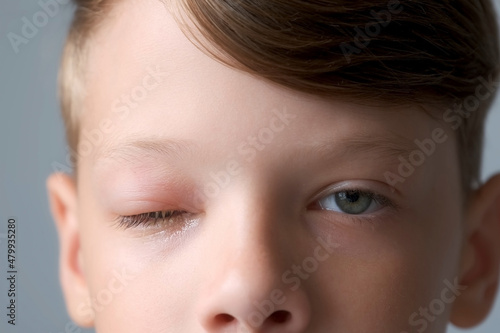 Obraz na plátně Face of boy with a swollen eye from an insect bite, closeup view