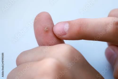 Big wart, verruca on human thumb finger before laser removing on grey backgroung, closeup view. Human papillomavirus, weakened immunity, treatment of warts. Doctor is touching boy's finger.