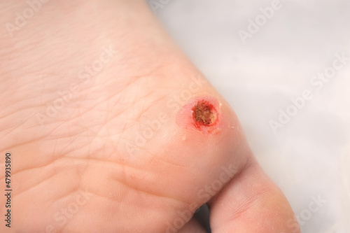 Wound of removed wart after laser removal on patient boy's foot, closeup view. One day surgery concept. Removed verruca papilloma on leg. One day surgery concept. Sore, wound after operation.