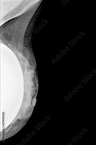 Mammography in middle-lateral projection of a left breast for the breast implants check