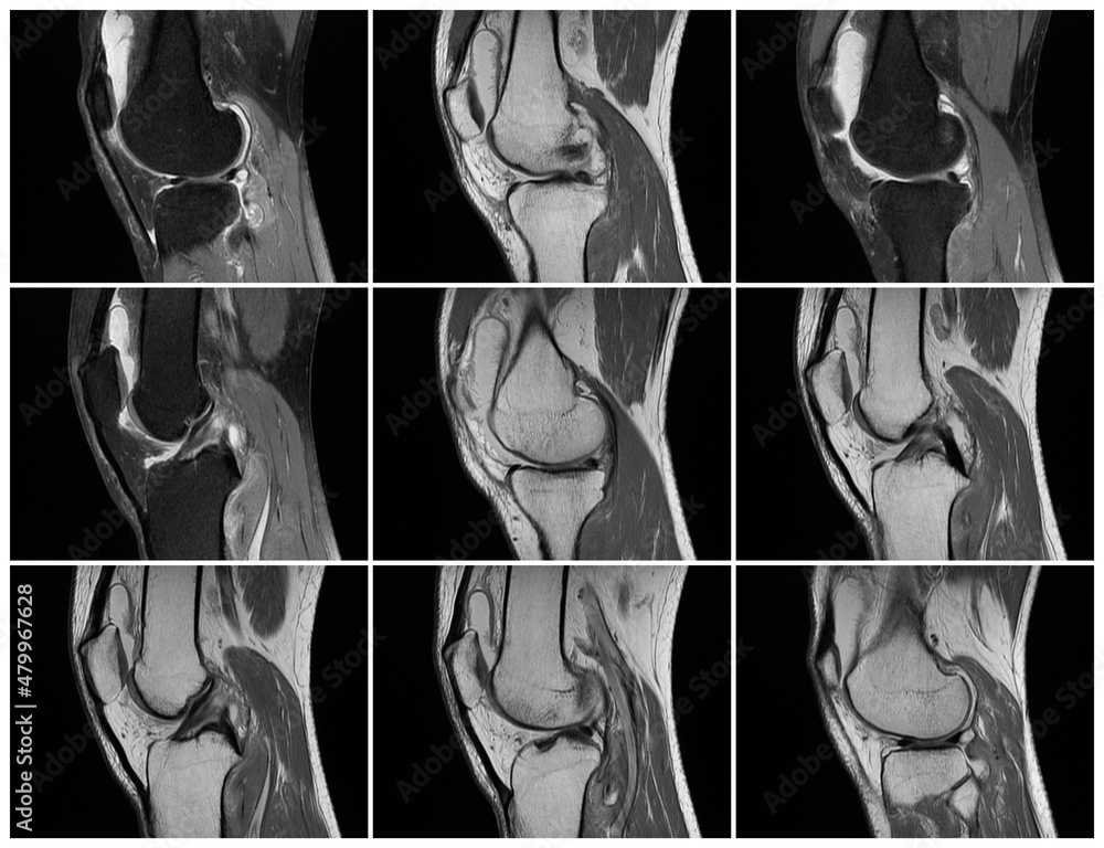 Plakat Resonance Imaging ,MRT images of knee.Acute psoriatic