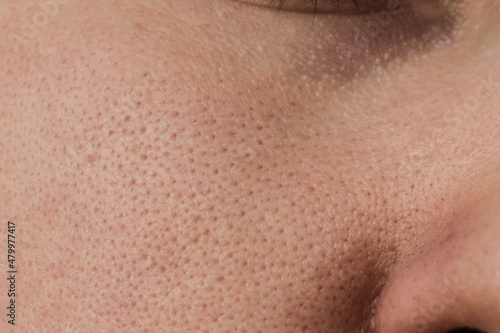 The skin of a woman's cheek with clogged pores before cleaning photo