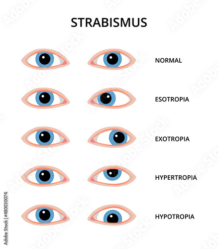 Types of strabismus. Eyes with esotropia, exotropia, hypertropia and hypotropia. Eyesight, eye examination, ophthalmology