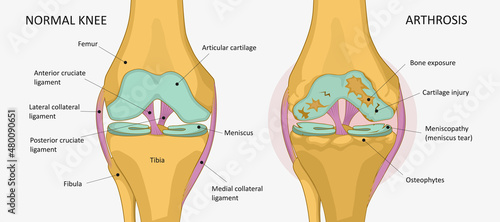 Knee arthrosis. Healthy knee and sore knee with damaged structure