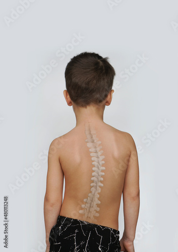 Scoliosis Spine Curve Anatomy, Posture Correction. Child with a deviated spine photo