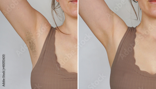 Foto Armpit before and after depilation, laser waxing and sugaring.