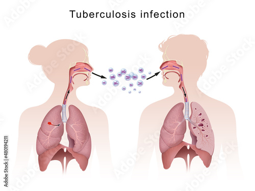 Принти на полотні Tuberculosis is spread from one person to the next through the air