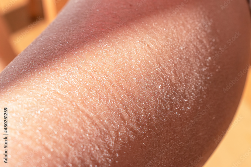 Concept of extremely dry and dehydrated skin of the body. Problem skin diagnosed with xerosi or dermatitis. Close up of chapped arms and legs. Selective focus of a itchy skin. Concept of extremely dry and dehydrated skin of the body. Problem skin diagnosed with xerosi or dermatitis. Close up of chapped arms and legs. Selective focus of a itchy skin.
