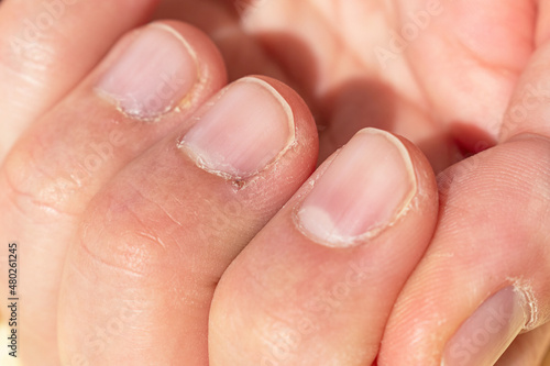 Close up on a male hands with dry skin and hangnails. Cuticles in bad condition. Chapped and neglected hands. Lack of manicure in a man fingers.