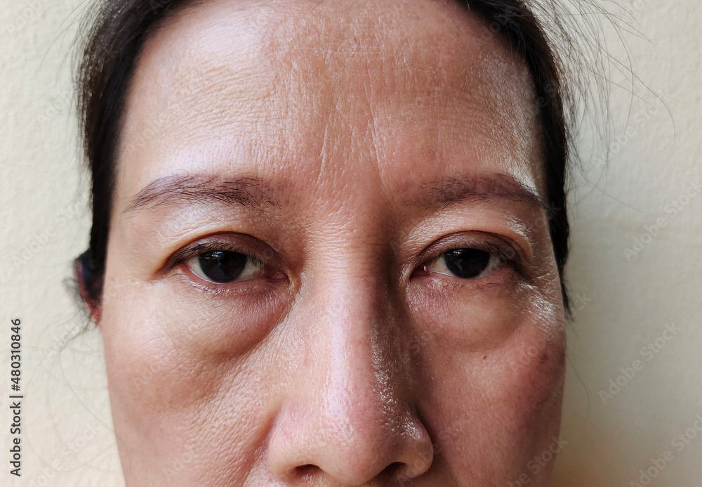 Fototapeta premium close up portrait a woman showing problems adipose hanging and flabbiness eyelid on the face.
