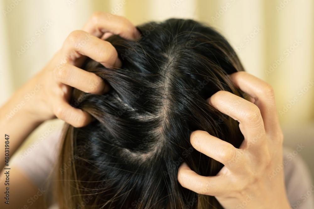 Naklejka premium Itching and irritation of the scalp It makes us unable to bear having to constantly scratch our heads.