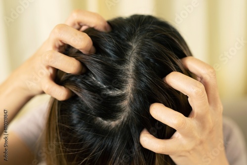 Itching and irritation of the scalp It makes us unable to bear having to constantly scratch our heads. photo
