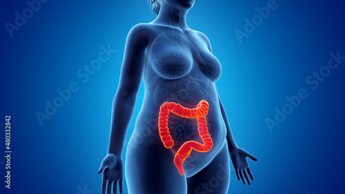3d rendered illustration of an obese womans colon