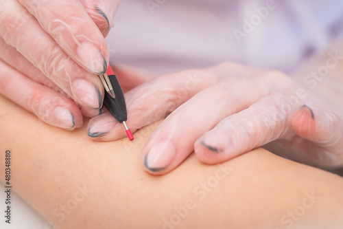 The doctor makes electro epilation of the woman's hands in the salon. Close-up of hardware removal of unwanted hair forever