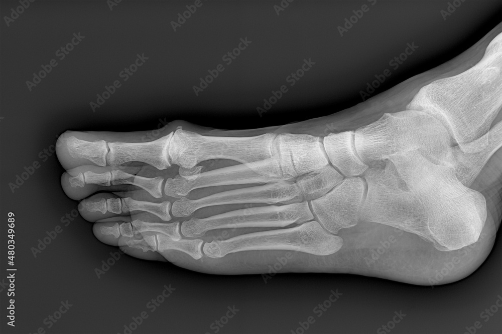 Radiography of the toes of one foot, in lateral-lateral projection ...
