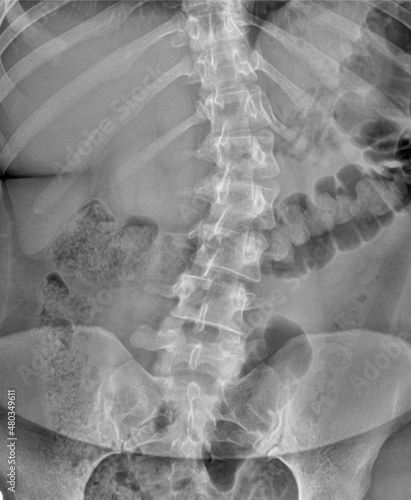 Lumbar Spine Radiography, in anteroposterior projection, of a patient with scoliosis
