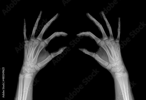 Radiography of the fingers of the hands in comparison