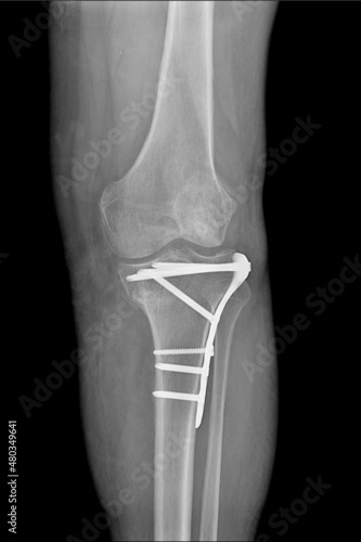 Radiography of the operated Tibia, in antero-posterior projection, in a patient after an accident