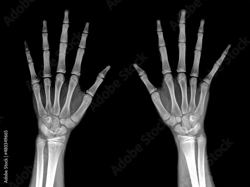 Comparison Radiography of hand left and right