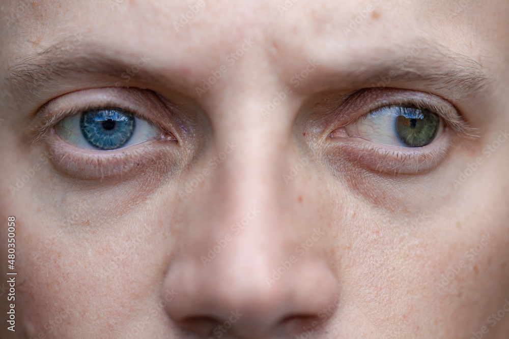 full face photo of a man with strabismus and blindness of one eye. visual disability full face photo of a man with strabismus and blindness of one eye. visual disability